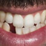 Зубик вставили